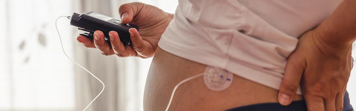 Pregnant woman operates insuline pump. Modern diabetes treatment through insulin given by a drainage mounted on belly.