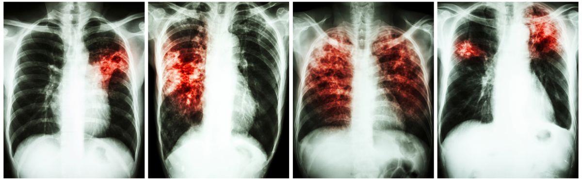 Scientists are working on blood tests to stop the spread of tuberculosis